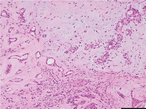 Histology Of Fnab Specimen Section Stained With He The Tumor Was