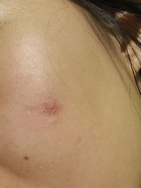 What Is This On My Face Is It An Early Stage Basal Cell Carcinoma Skin