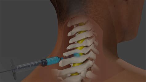 Cervical Epidural Injection In Neck