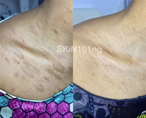 Pityriasis Rosea Treatment Before And After Skin101