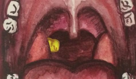 They Hide In Tonsils And Are A Big Reason Why People Have Bad Breath
