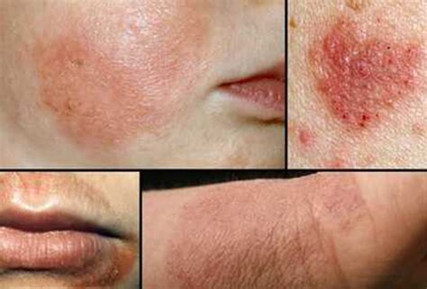What Is Atopic Dermatitis Symptoms Causes And Diagnosis