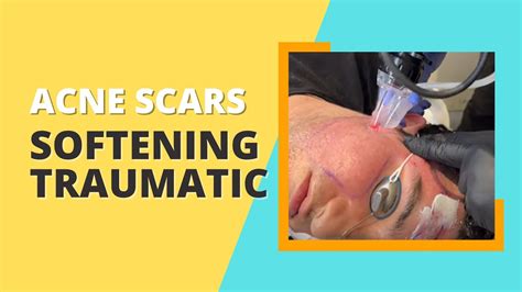 Softening Traumatic Acne Scars With Co2 Laser Dr Jason Emer Youtube