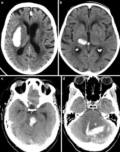 Imaging Of Spontaneous Nontraumatic Intracerebral Hemorrhage