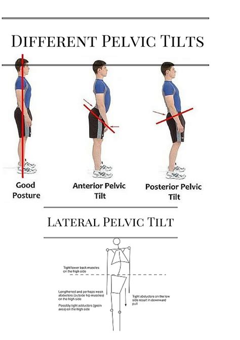 Exercises For Anterior Pelvic Tilt