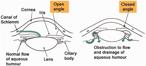 Acute Angle Closure Glaucoma A Potential Blind Spot In Critical Care