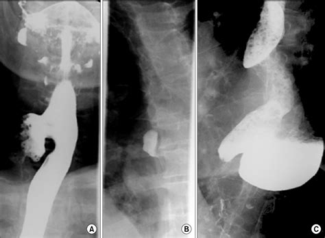 Figure 1 From Surgical Treatment Of The Esophageal Diverticulum
