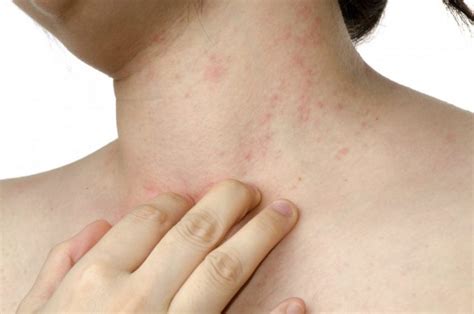 Аллергия на коже 140 фото и видео высыпаний и советы по лечению