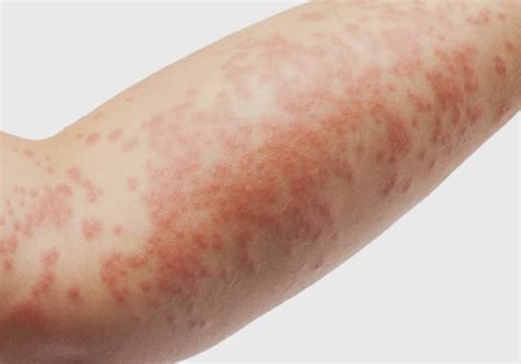 Dermatite At Pica Conhe A Os Sintomas E Tratamentos Dermacenter Alto