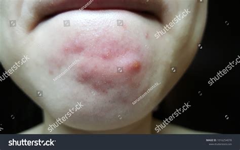 Closeup Of Infected Sebaceous Glands And Red Royalty Free Stock Photo
