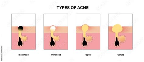 Type Of Acne Diagram Blackhead Whitehead Papule Pustule Skin