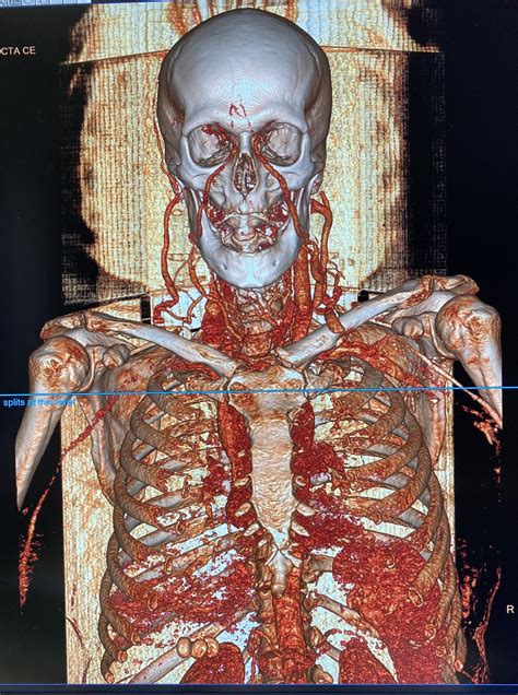 3d Ct Scan Of The Arteries Of A Human Head And Neck Mental Human