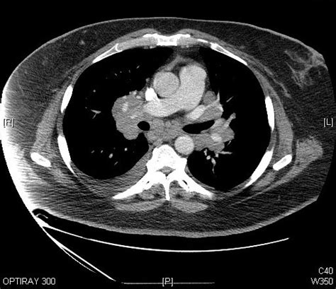 Sarcoidosis Chest Ct Scan Case 242 A Photo On Flickriver