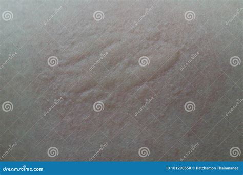 Close Up Of The Skin Surface For Women With Allergic Rash Redness