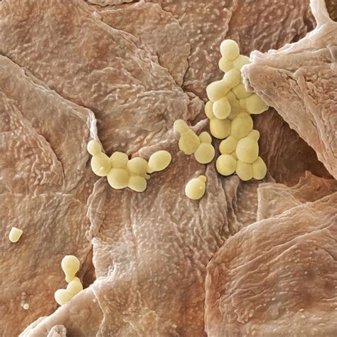 Yeast Skin Fungal Infection
