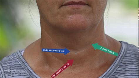 Top 3 Visual Signs Of Thyroid Disease Youtube
