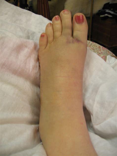 Sometimes—it depends on the type of break. Candelyn's Plate: Top Ten Reasons NOT to Break Your Foot