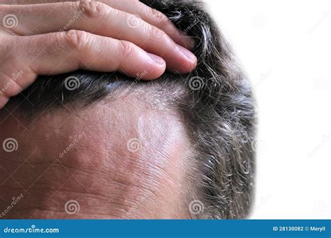 Dandruff Skin Issue Stock Photo Image Of Itch Problem 28130082