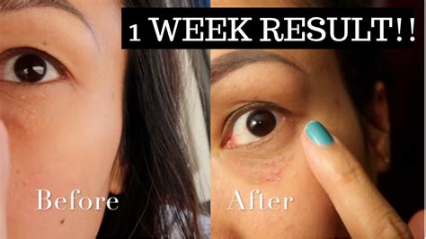 Removing My Under Eye Milia Before And After Results 1 Week