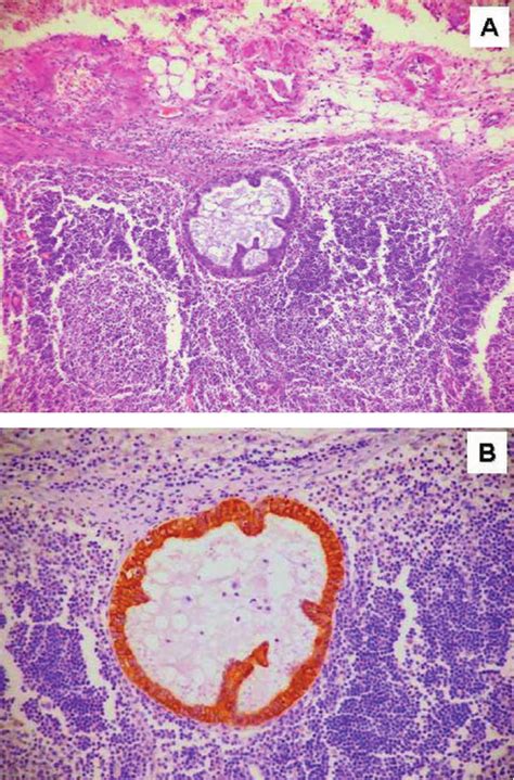 Benign Epithelial Inclusion In A Pelvic Lymph Node Located In The