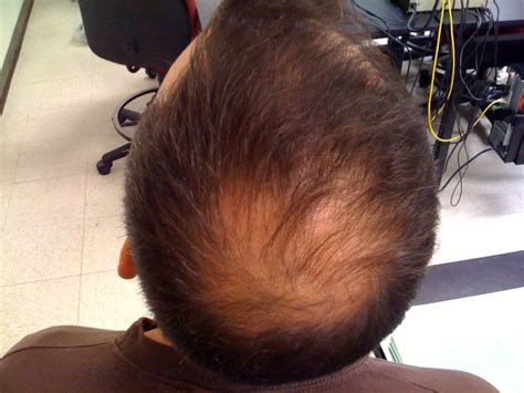 It can be the result of heredity, hormonal changes, medical conditions or a normal part of aging. Pattern hair loss - Wikipedia