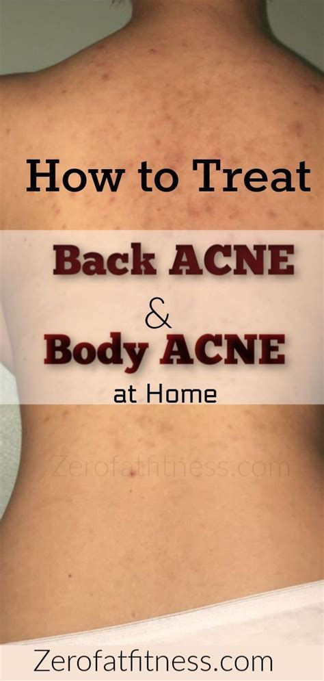 How To Get Rid Of Back Acne Overnight At Home 9 Natural Remedies For Back Acneacne Is One Of