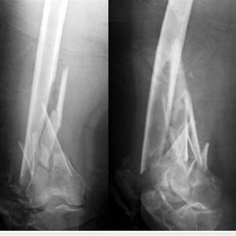 Pre Operative X Rays X Rays Show A Comminuted Ao Type C2