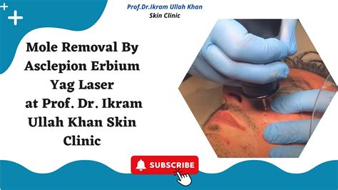 Mole Removal By Asclepion Erbium Yag Laser At Profdr Ikram Ullah Khan Skin Clinic Youtube