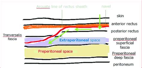 Surgical Anatomy Of Abdominal Wall For Tep Download Scientific Diagram