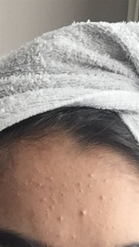 Tiny Small Bumps On Forehead Clogged Pores General Acne Discussion