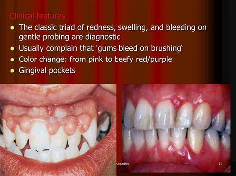 Ppt Gingivitis Inflammation Of Gingival Tissues Commonly Associated