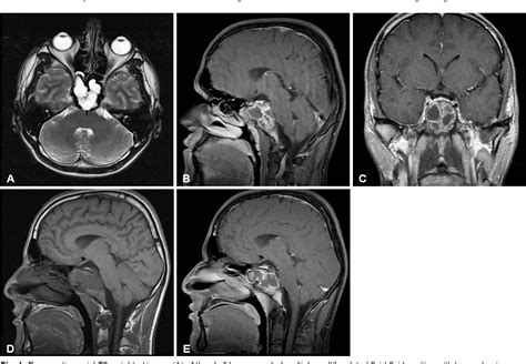 Figure 1 From Aneurysmal Bone Cyst Of Sphenoid Bone And Clivus