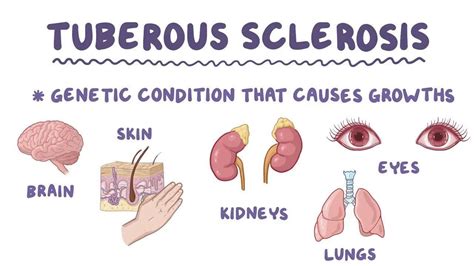 Medical School Tuberous Sclerosiswhat To Know Tuberous Sclerosis