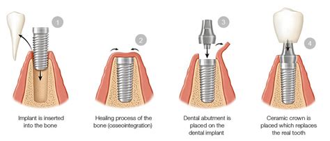 Biohorizons Dental Implants Downtown Toronto Dentist