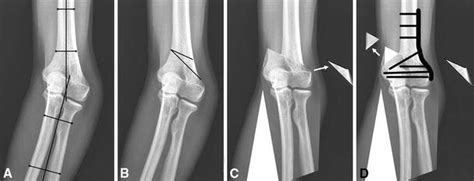 Oblique Closing Wedge Osteotomy And Lateral Plating For Cubitus Varus