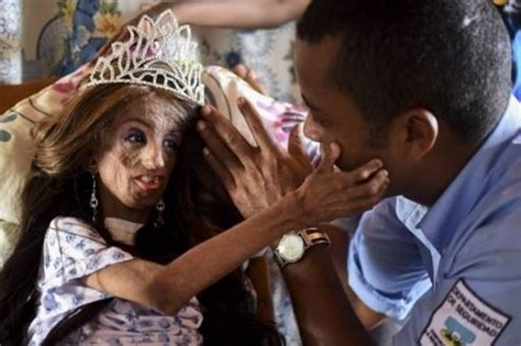 Muere A Los 16 Años La Niña Colombiana Con Envejecimiento Prematuro