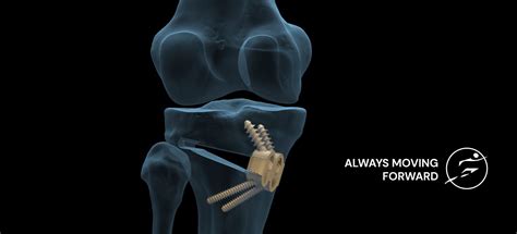 Knee Osteotomy Kinds Of Osteotomy Dr Vinay Tantuway