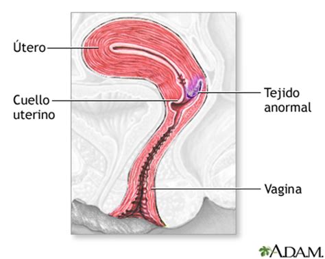 Displasia cervical SerieIndicaciones MedlinePlus enciclopedia médica