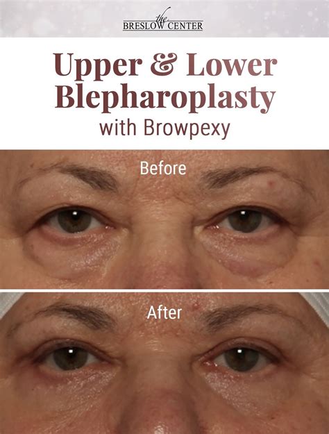 Patient Was Unhappy With Her Droopy Upper Eyelids And Puffy Lower