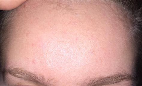 Small Red Bumps On Forehead