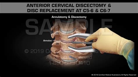Anterior Cervical Discectomy Disc Replacement At C C Medical Animation YouTube