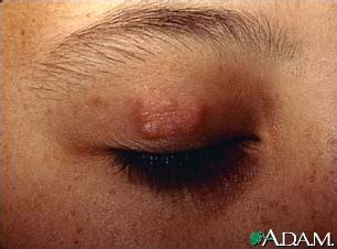 Granuloma Annulare On The Eyelid Medlineplus Medical Encyclopedia Image