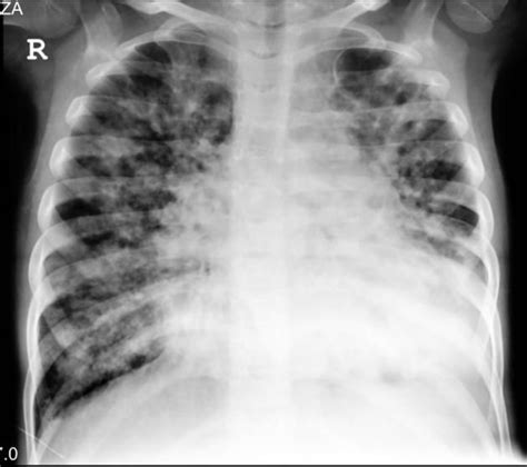 Cystic Fibrosis Chest X Ray
