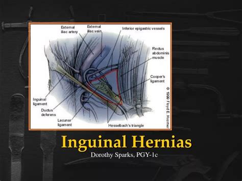 Ppt Inguinal Hernias Powerpoint Presentation Free Download Id218475