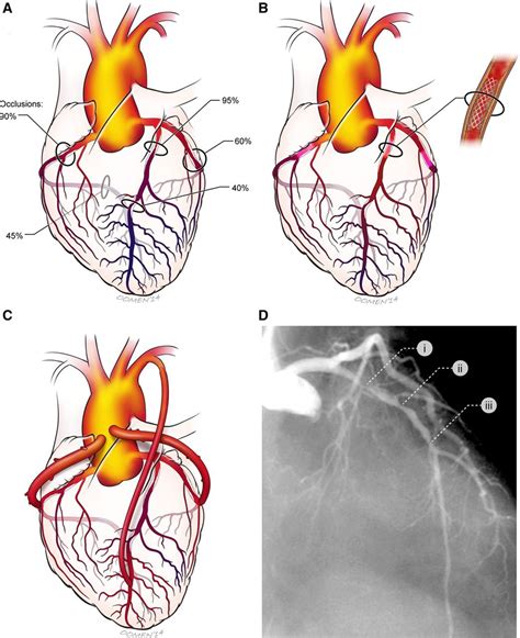 Coronary Artery Revascularization In Patients With Diabetes Mellitus