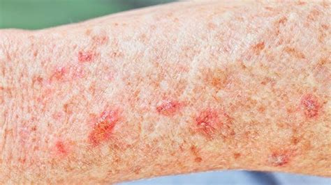 12 Skin Conditions You Should Know About Everyday Health Skin Rash