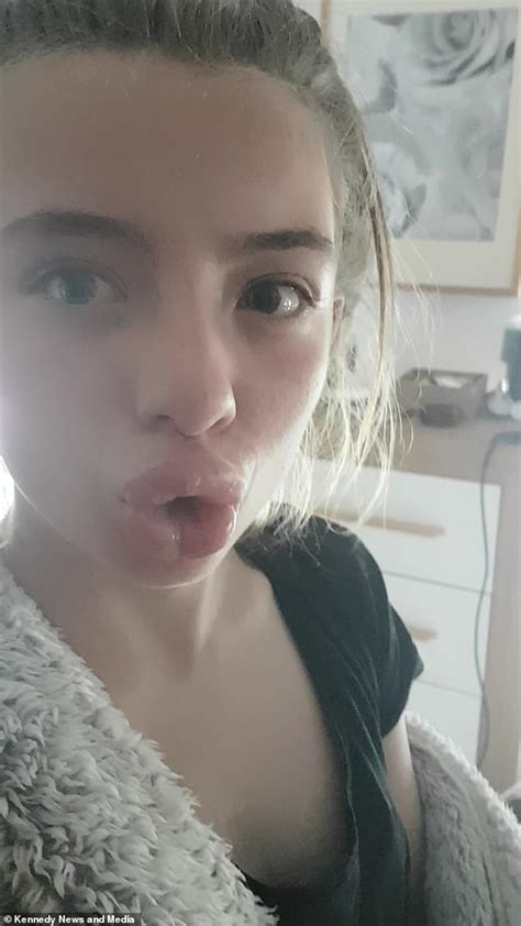 Mother In Stitches As Teenage Babe Gets Stuck With Duck Lips For Two Days Express Digest