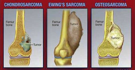 Types Of Bone Cancer