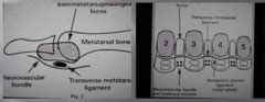 A neuroma is a thickening of nerve tissue, or more correctly a neurofibroma. pod surg II entrapment neuropathy Flashcards | Quizlet
