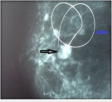 Mammogram Of Left Breast Showing A 25 Cm X 15 Cm Lobulated Lesion